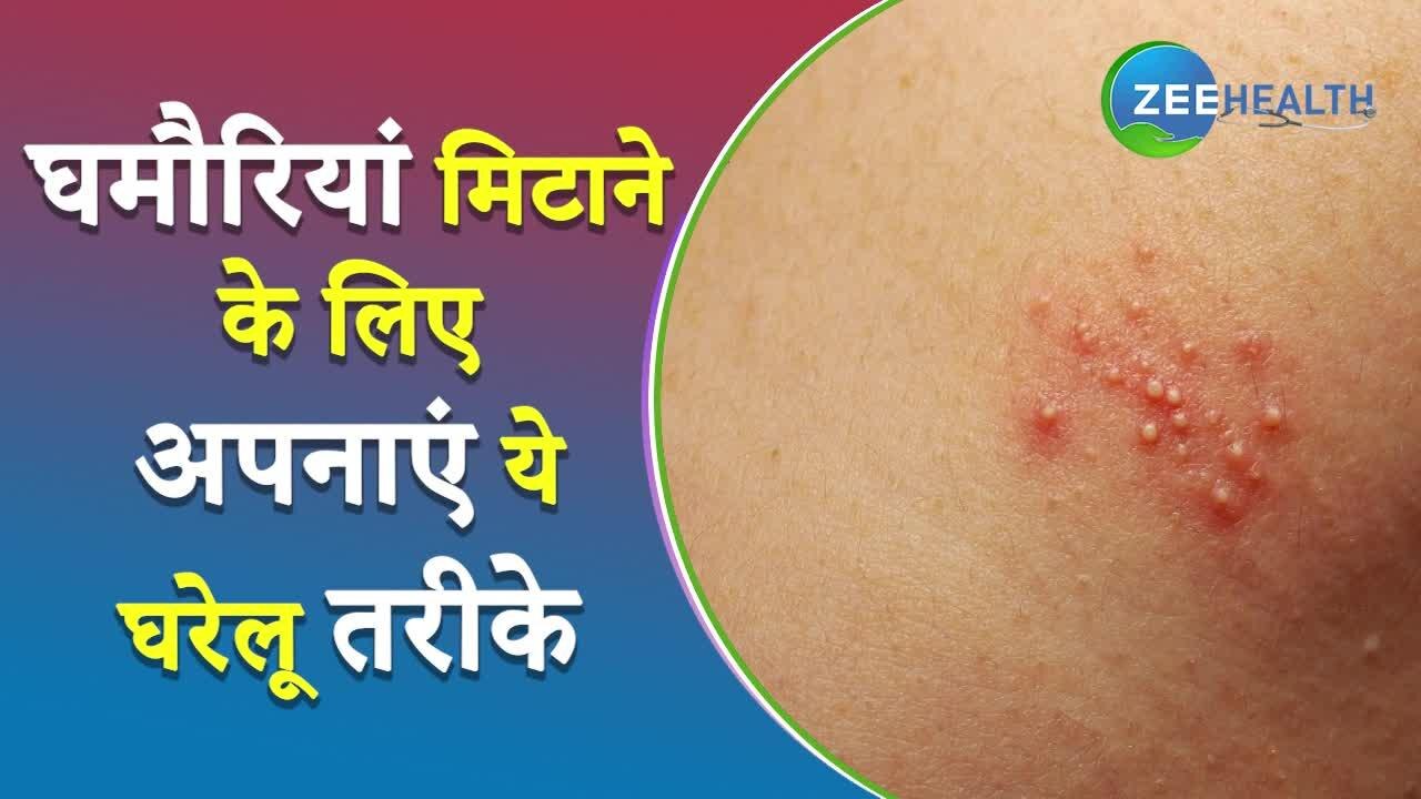 Home Treatment Of Prickly Heat In Summers Janiye Ghamori Ka Ilaj Samp