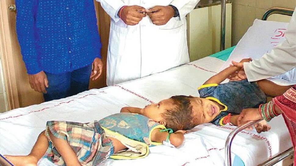 Odisha Conjoined Twins In Critical Condition After Surgery In Aiims सिर से जुड़े बच्चों जागा