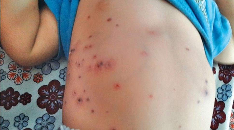 Scrub typhus is dangerous disease Scrub typhus is dangerous disease