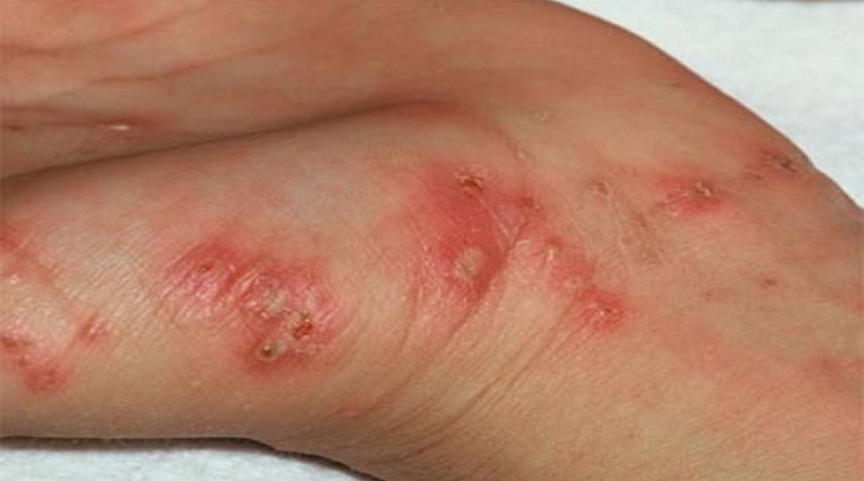 Scrub typhus Scrub typhus
