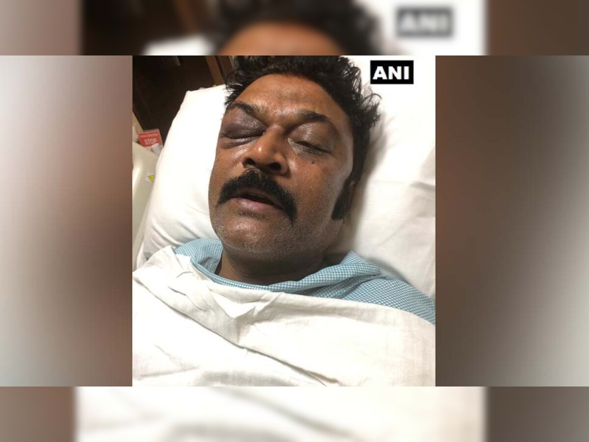 कांग्रेस विधायकों में मारपीट के बाद सामने आई घायल MLA की तस्वीर, गणेश के खिलाफ FIR