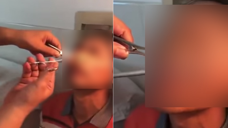 Video: शख्स की नाक से 10 दिनों से लगातार बह रहा था खून, डॉक्टर ने देखा तो चिपकी थीं इतनी जोंक