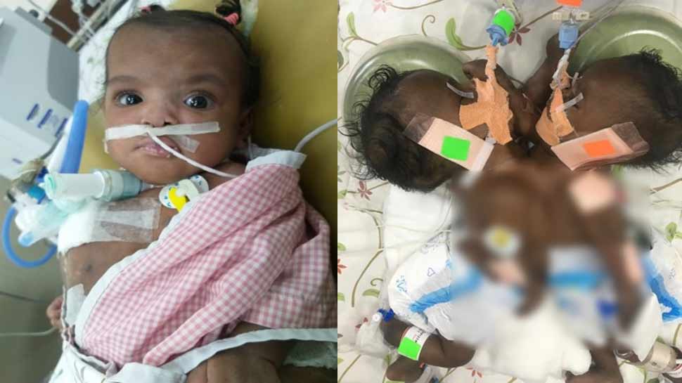 क्लिआन का जब जन्म हुआ तो उसका बदन अपनी जुड़वां बहन से जुड़ा हुआ था, इसे मेडिकल भाषा में कॉन्जॉइंड ट्वीन्स कहा जाता है. क्लिआन का जब जन्म हुआ तो उसका बदन अपनी जुड़वां बहन से जुड़ा हुआ था, इसे मेडिकल भाषा में कॉन्जॉइंड ट्वीन्स कहा जाता है.