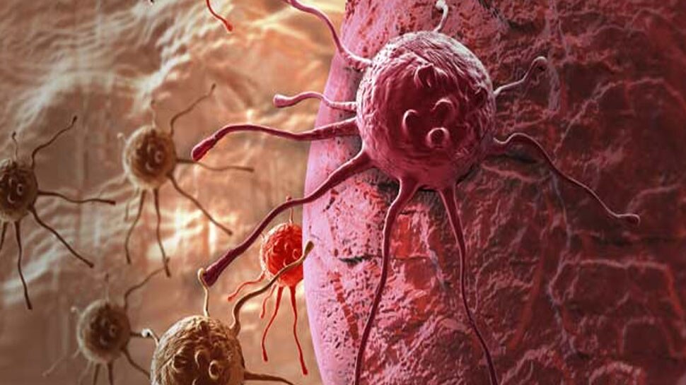 कई सालों में विकसित होता है पेट का कैंसर Stomach cancer develops in many years