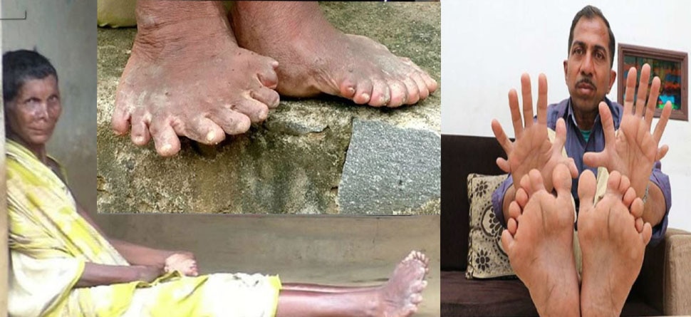 ଜାଣନ୍ତୁ ୩୧ଟି ଆଙ୍ଗୁଠି ଥିବା ୬୩ ବର୍ଷିୟା ମହିଳାଙ୍କ ଦୁଃଖ କାହାଣୀ