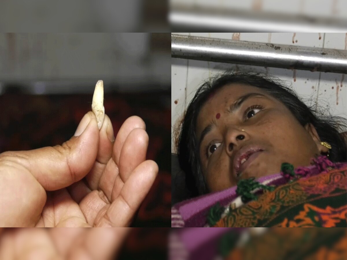 रतलाम डॉक्टर के घूंसे से टूटा महिला का दांत और अस्पताल में भर्ती पीड़िता.