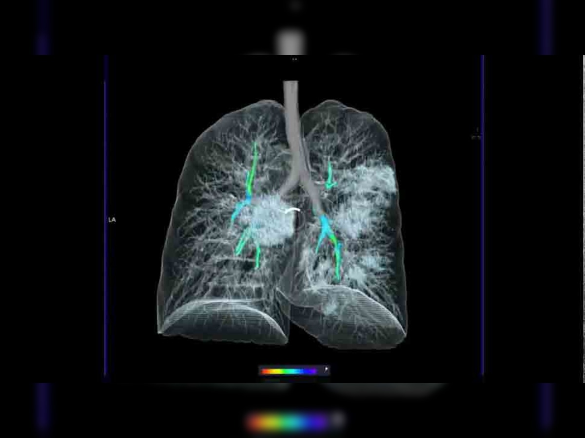ये 3-D तस्वीर Radiological Society of North America (RSNA) ने जारी की है. 