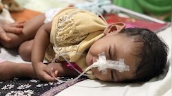 यूपी में दो साल के भीतर खत्म हो जाएगा दिमागी बुखार, अंतिम दौर की चल रही लड़ाई