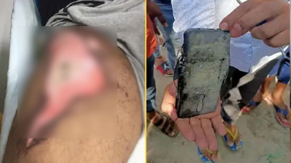 जेब में रखे मोबाइल में हुआ धमाका, ज़ख्मी शख्स को अस्पताल में कराया दाखिल जेब में रखे मोबाइल में हुआ धमाका, ज़ख्मी शख्स को अस्पताल में कराया दाखिल