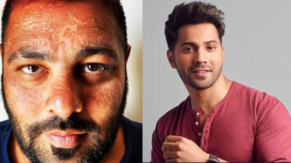 बादशाह का चेहरा बुरी तरह झुलसा, फोटो देख Varun Dhawan ने भी बताया अपना दर्द