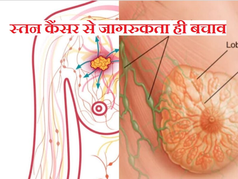 Breast cancer awareness: कल कहीं देर न हो जाए