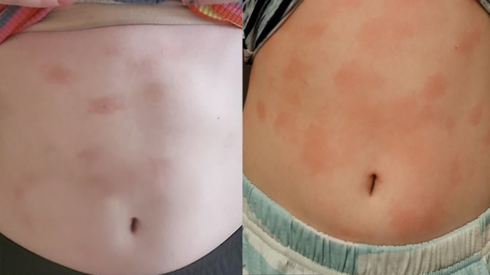 12yearold Danielle McCraven is so allergic to water that having a shower could kill her