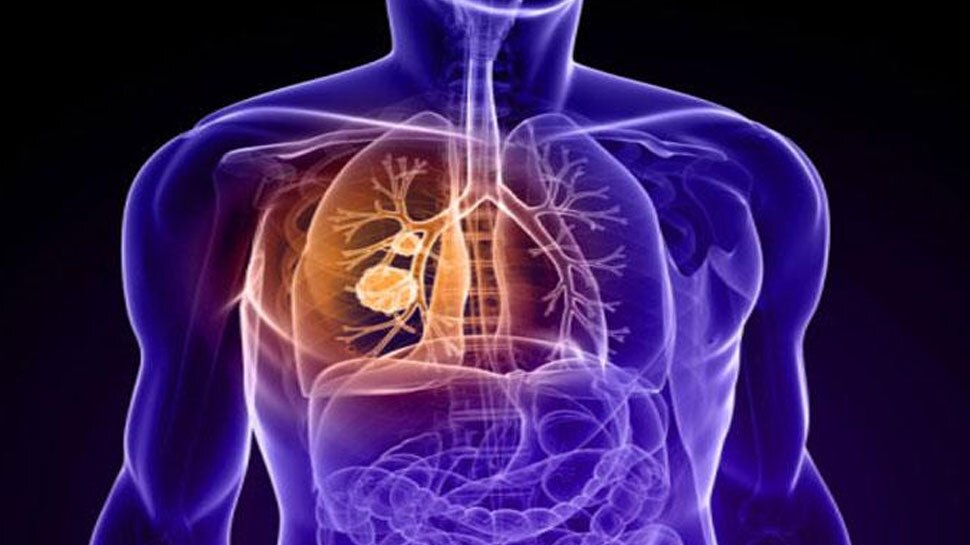 Coronavirus damages the lungs, many covid patients showed punctured