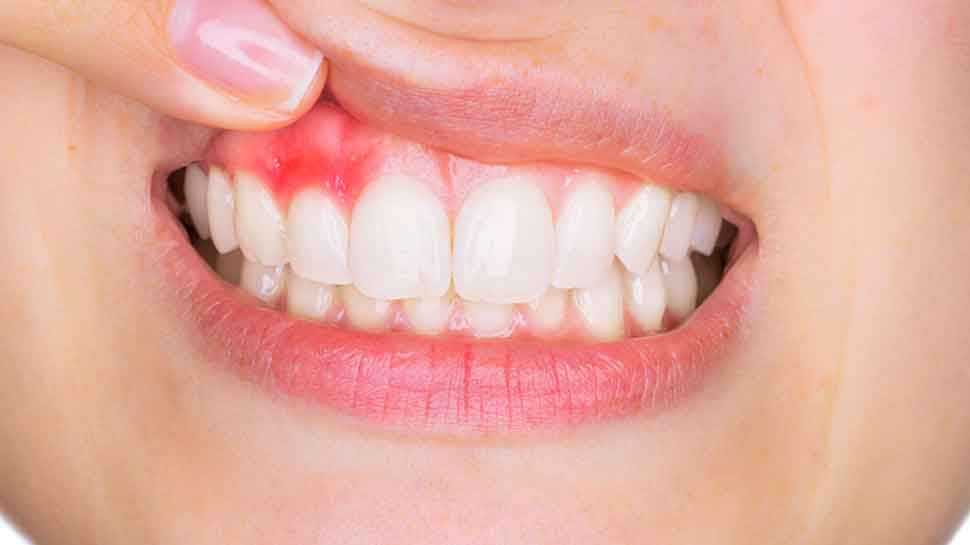 मसूड़ों की बीमारी बढ़ा सकती है किडनी की समस्या, रिसर्च में पहली बार सामने आई ये बात
