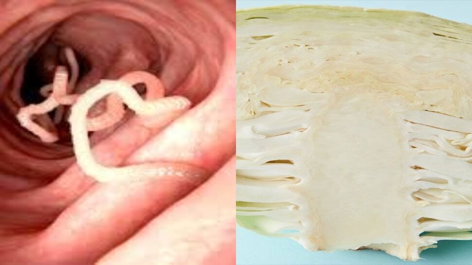 Cabbage Tapeworm Vegetable Taeniasis Neurocysticercosis ଖାଇବା ପଡିପାରେ