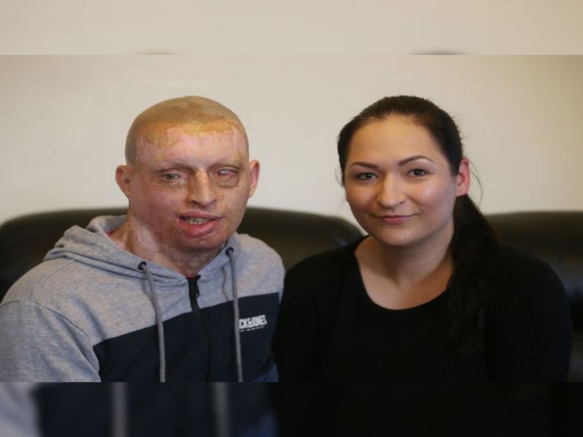 acid attack ex girlfriend poured acid on boyfriends mouth while he ...