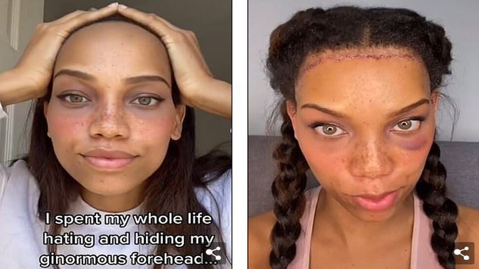 महिला ने अपने माथे की सर्जरी करवा साइज कराया छोटा, आया इतना खर्च