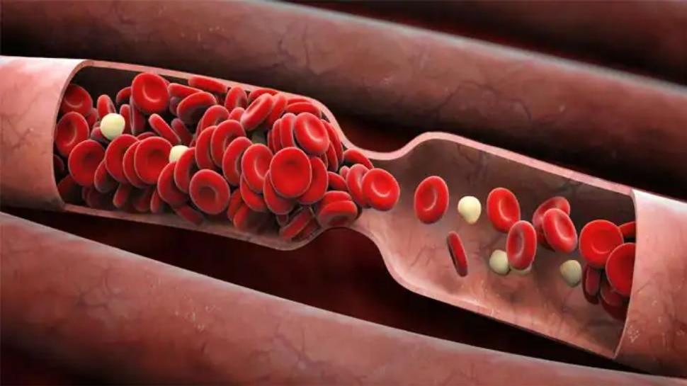 Blood Clot Signs: त्वचा के रंग में बदलाव से लेकर सूजन तक, ब्लड क्लॉट के इन संकेतों को नजरअंदाज न करें