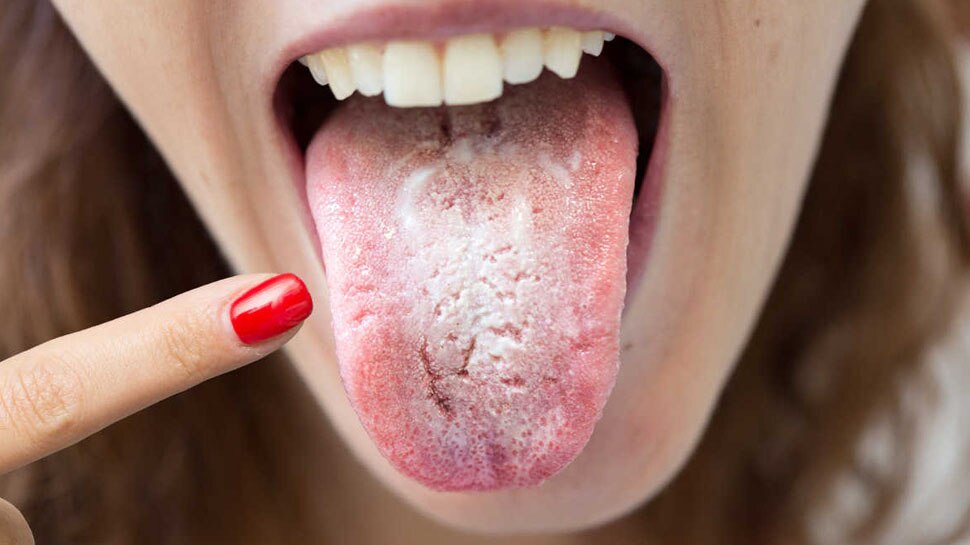 Corona: know what is COVID Tongue, how can identify symptoms |COVID