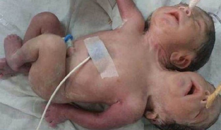 ओडिशा में दो सिर और तीन हाथ के साथ हुआ जुड़वां बच्चियों का जन्म