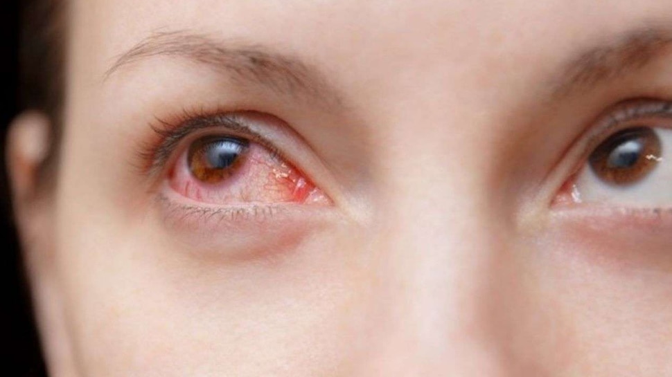 आंखों का लाल होना coronavirus symptoms red eyes