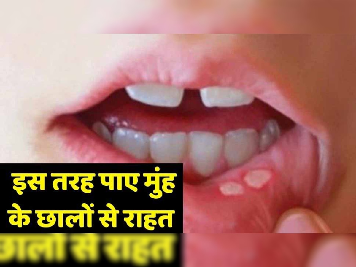 health Tips: मुंह में बार-बार हो रहे हैं छाले तो ये आसान से घरेलू उपाय हैं रामबाण