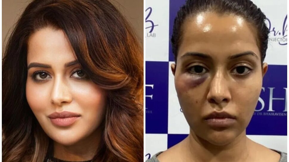 Tamil Actress Raiza Wilson ने चेहरा खराब करने वाली डॉक्टर से मांगा हर्जाना, एक करोड़ रुपए की रखी मांग