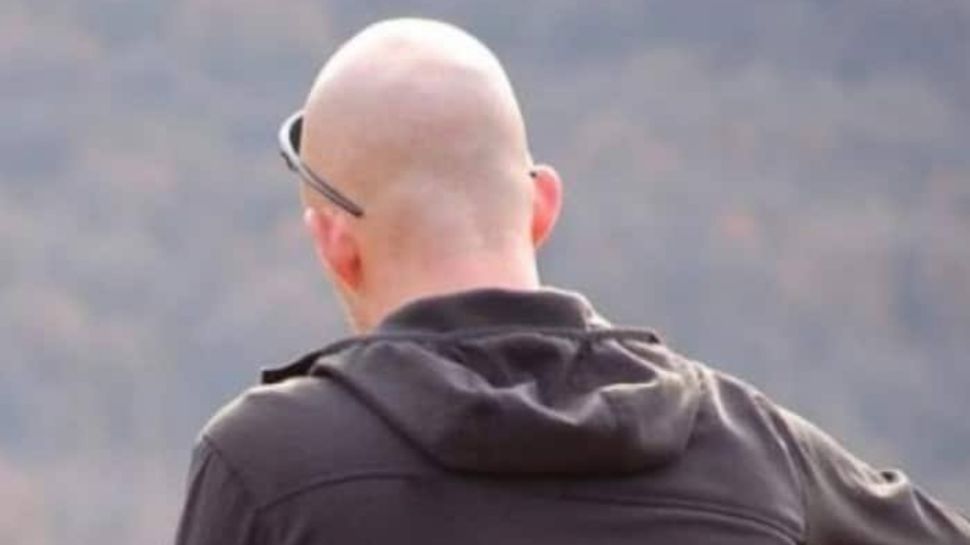 androgenetic alopecia androgenetic alopecia