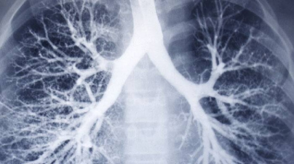 फेंफड़ों में इन्फ्लेमेशन Inflammation in lungs
