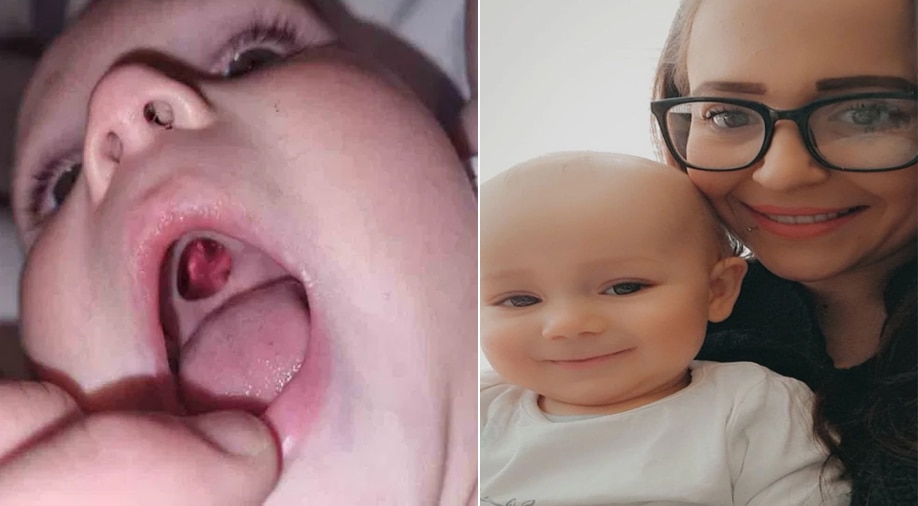 बच्चे के मुंह में छेद देख घबरा गई मां, हॉस्पिटल पहुंची तो पता चला जिसे वो सुराख समझ रही है वो असल में Sticker है