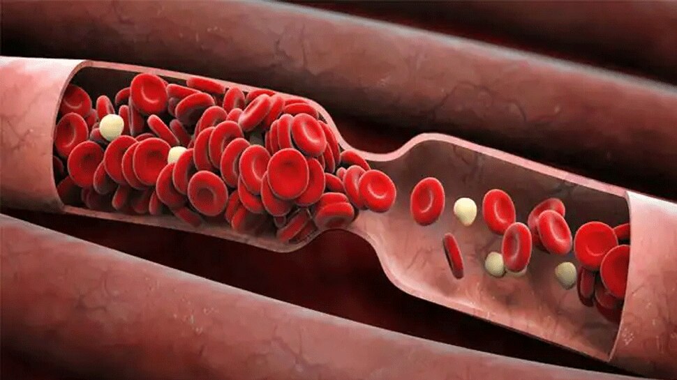 Why blood clotting happens in patients 