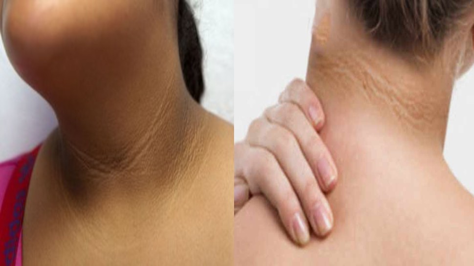 Skin Care news: गर्दन के कालेपन से छुटकारा दिलाएंगे यह घरेलू उपाय, जानें इस्तेमाल करने का तरीका