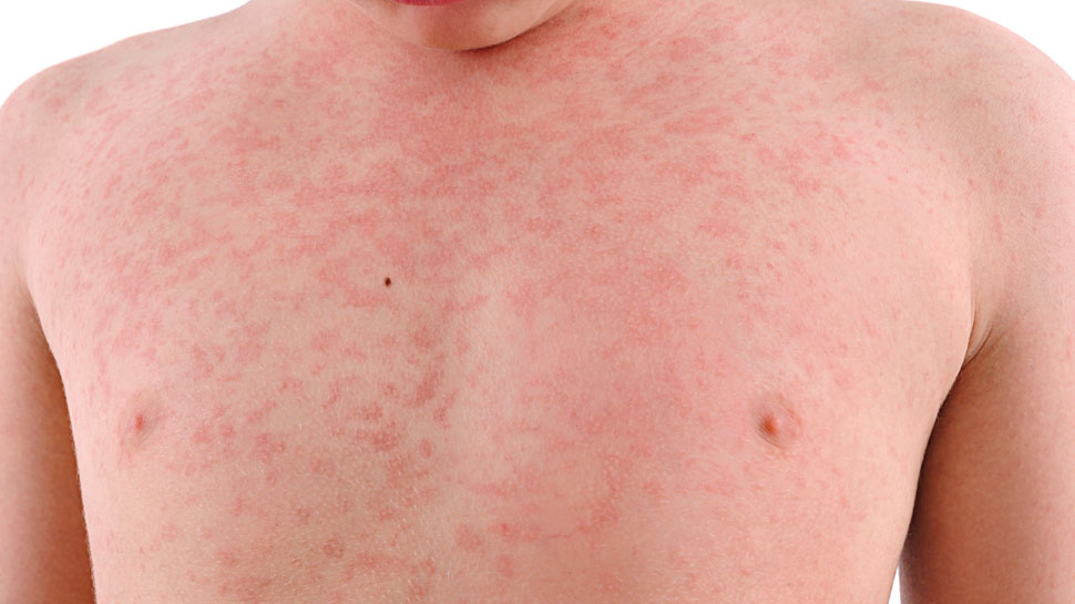 ऐसे होती है घमौरी Such are the heat rash