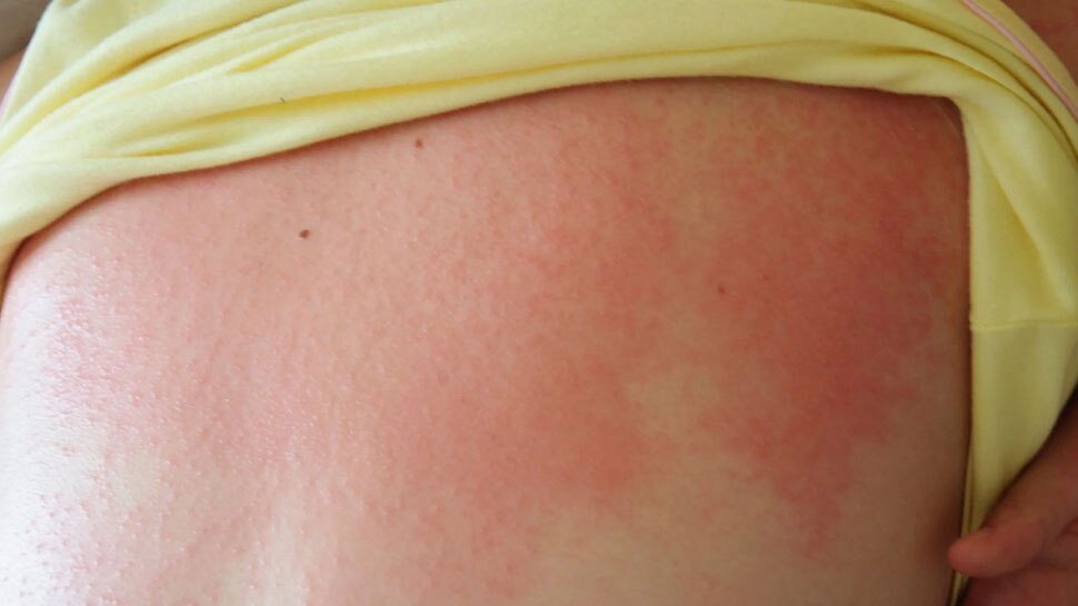 ऐसे करें घरेलू उपचार do home remedies like this