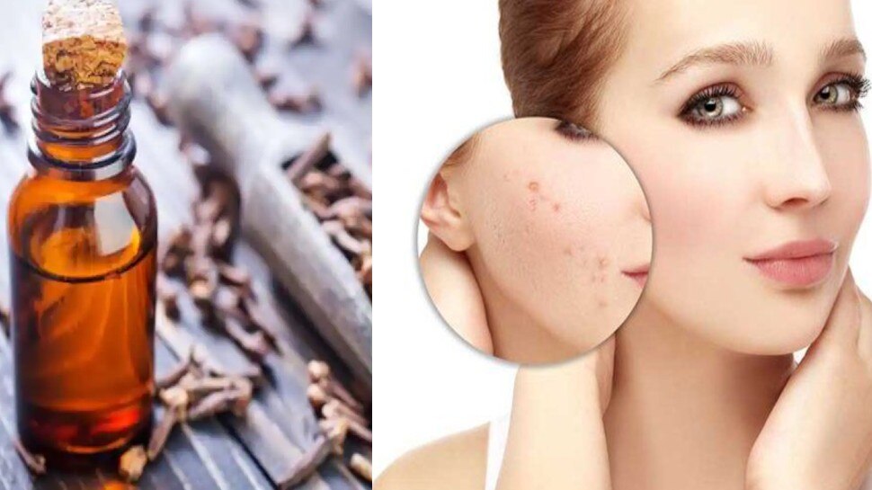 Clove is beneficial in removing facial scars know here Make your face