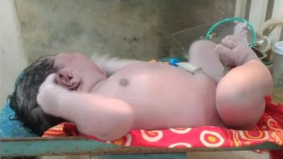 Assam में 5.2 किलो के बच्चे का जन्म, डॉक्टरों का दावा- राज्य का सबसे वजनी Baby