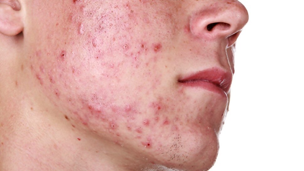 Health news: चेहरे को खूबसूरत बनाएंगी ये तीन चीजें, दाग-धब्बे और मुंहासे हो जाएंगे गायब, जानें अन्य फायदे