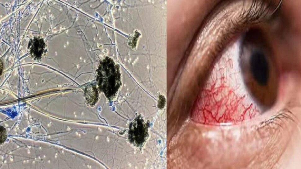 बीएचयू में ब्लैक फंगस से 3 मरीजों की मौत, अब तक 62 ने गंवाई जान, 136 का इलाज जारी