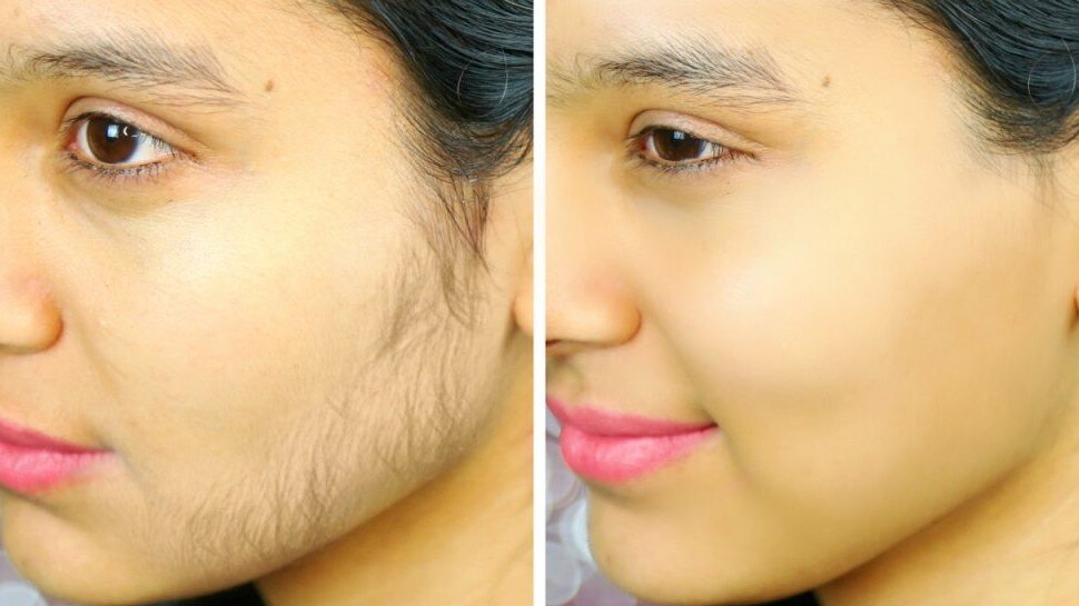How to Remove Facial Hair At Home  RealSelf News
