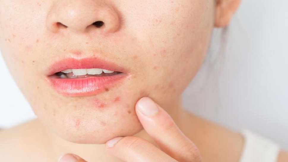 Skin Care Tips: मुंहासे खत्म करेंगे ये 7 फूड्स, त्वचा बन जाएगी एकदम बेदाग और ग्लोइंग