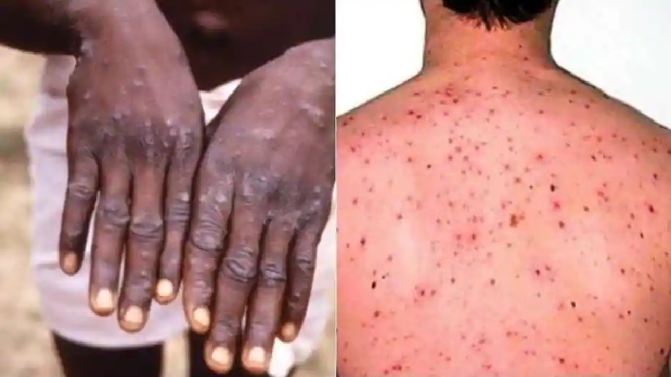 US के Texas में सामने आया दुर्लभ वायरस Monkeypox का First Case, कॉन्‍टेक्‍ट ट्रैसिंग में जुटी CDC