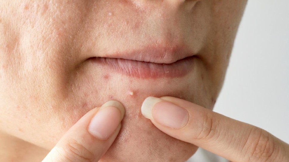 Skin care Tips Follow these tips to avoid face and skin pimples pimple se  bachne ka upay brmp | face को हमेशा साफ-सुधरा रखना है तो 5 गलतियां कभी न  करें, आपको