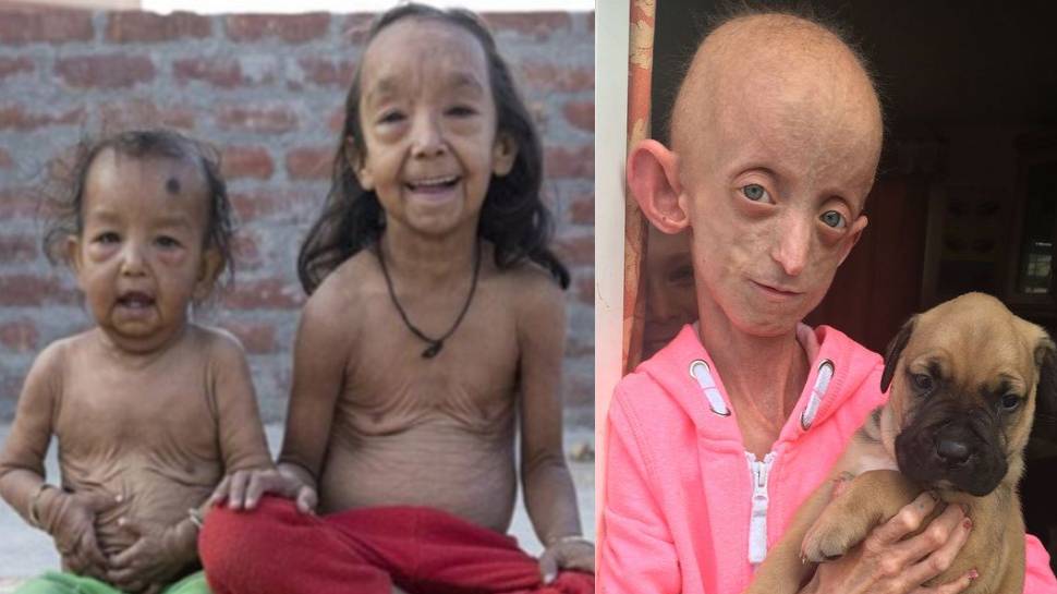 Rare Disease: एक ऐसी दुर्लभ बीमारी, जिसमें 10 साल का बच्चा दिखने लगता है 100 साल का, जानें लक्षण