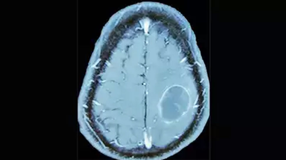 abscess formed in the patient's brain