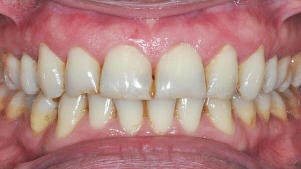 dental care tips best home remedy to remove stain and yellow colour to get  teeth whitening janiye daant chamkane ka tarika samp | Dental Care Tips: ये  है दांत साफ करने का