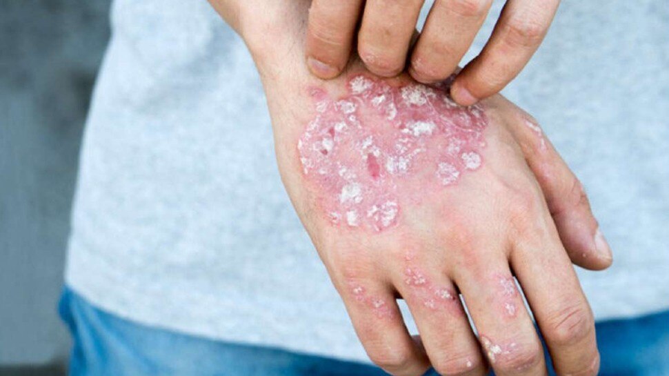 company forced to wash hands 17 to 20 times Employee wins 50000 euro over  skin Disease | दिन में 20 बार हाथ धुलवाती थी कंपनी, Skin Disease होने पर  देने पड़े 44 लाख रुपये Hindi News,