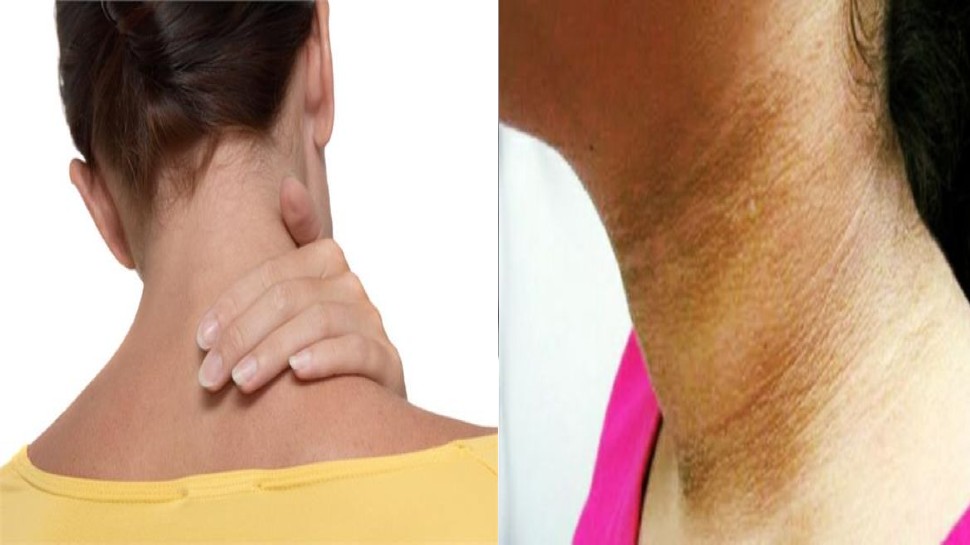 remove blackness of neck: गर्दन का कालापन मिनटों में दूर कर देंगी ये चीजें, जानें उपयोग का आसान तरीका