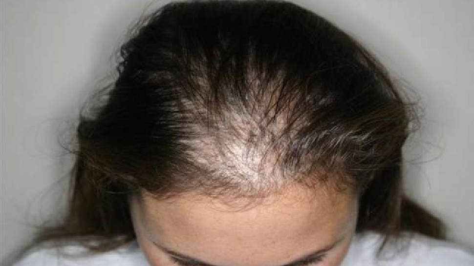 Tips for Hair Care: बालों को झड़ने से रोक देंगे यह घरेलू उपाय, hair हो जाएंगे मजबूत, काले और घने