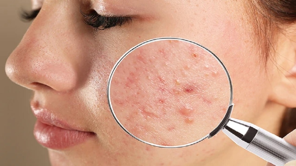 acne and pimple patch remove pimples and acne overnight know pimple treatment samp | Overnight Pimple Removal: रात में लगाएं ये चीज, सुबह तक बिल्कुल गायब हो जाएगा पिंपल, दाग भी नहीं