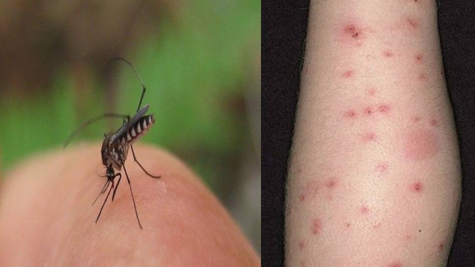 World Mosquito Day 2021: मच्छर के काटने पर अपनाएं ये उपाय, ना होगी खुजली और ना पड़ेगा दाग